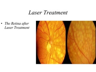 Laser Treatment The Retina after Laser Treatment   