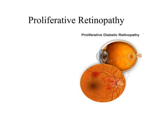 Proliferative Retinopathy  