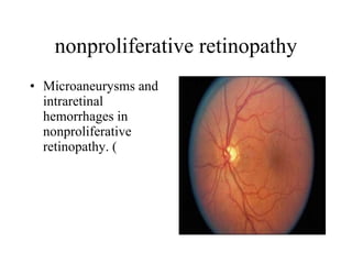 nonproliferative retinopathy Microaneurysms and intraretinal hemorrhages in nonproliferative retinopathy. (  