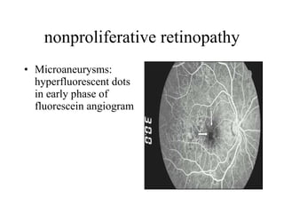 nonproliferative retinopathy Microaneurysms: hyperfluorescent dots in early phase of fluorescein angiogram  