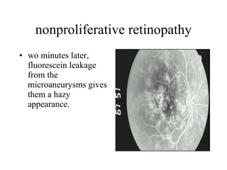 nonproliferative retinopathy wo minutes later, fluorescein leakage from the microaneurysms gives them a hazy appearance.  