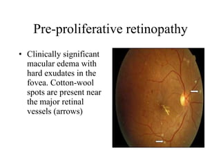 Pre-proliferative retinopathy Clinically significant macular edema with hard exudates in the fovea. Cotton-wool spots are present near the major retinal vessels (arrows)  