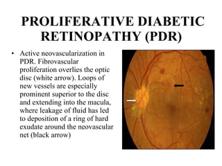 PROLIFERATIVE DIABETIC RETINOPATHY (PDR)   Active neovascularization in PDR. Fibrovascular proliferation overlies the optic disc (white arrow). Loops of new vessels are especially prominent superior to the disc and extending into the macula, where leakage of fluid has led to deposition of a ring of hard exudate around the neovascular net (black arrow)  