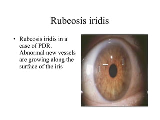 Rubeosis iridis Rubeosis iridis in a case of PDR. Abnormal new vessels are growing along the surface of the iris  