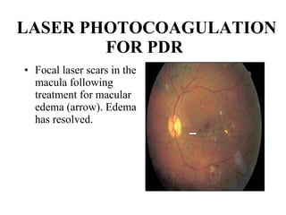 LASER PHOTOCOAGULATION FOR PDR   Focal laser scars in the macula following treatment for macular edema (arrow). Edema has resolved.  