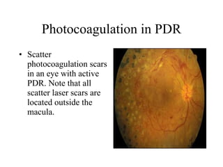 Photocoagulation in PDR Scatter photocoagulation scars in an eye with active PDR. Note that all scatter laser scars are located outside the macula.  
