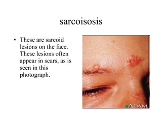 sarcoisosis These are sarcoid lesions on the face. These lesions often appear in scars, as is seen in this photograph.  