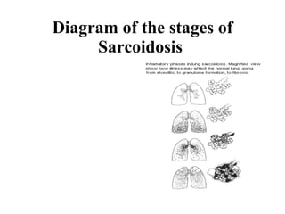 Diagram of the stages of Sarcoidosis   