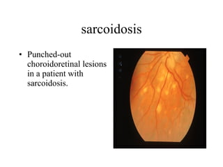 sarcoidosis Punched-out choroidoretinal lesions in a patient with sarcoidosis.  