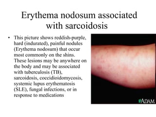   Erythema nodosum associated with sarcoidosis  This picture shows reddish-purple, hard (indurated), painful nodules (Erythema nodosum) that occur most commonly on the shins. These lesions may be anywhere on the body and may be associated with tuberculosis (TB), sarcoidosis, coccidioidomycosis, systemic lupus erythematosis (SLE), fungal infections, or in response to medications  