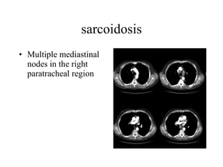 sarcoidosis Multiple mediastinal nodes in the right paratracheal region  