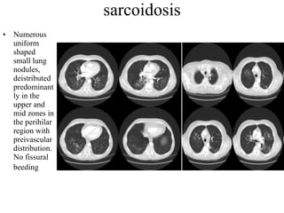 sarcoidosis Numerous uniform shaped small lung nodules, deistributed predominantly in the upper and mid zones in the perihilar region with preivascular distribution. No fissural beeding   