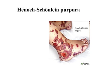 Henoch-Schönlein purpura 