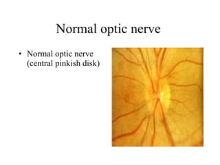 Normal optic nerve  Normal optic nerve (central pinkish disk)  