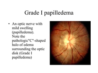 Grade I papilledema An optic nerve with mild swelling (papilledema). Note the pathologic"C"-shaped halo of edema surrounding the optic disk (Grade I papilledema)  