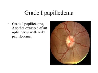 Grade I papilledema Grade I papilledema, Another example of an optic nerve with mild papilledema.  