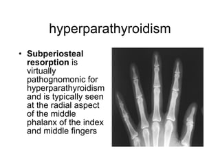 hyperparathyroidism Subperiosteal resorption  is virtually pathognomonic for hyperparathyroidism and is typically seen at the radial aspect of the middle phalanx of the index and middle fingers   