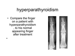 hyperparathyroidism Compare the finger on a patient with hyperparathyroidism, to his normal appearing finger after treatment   