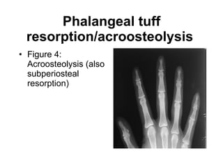 Phalangeal tuff resorption/acroosteolysis   Figure 4: Acroosteolysis (also subperiosteal resorption)   
