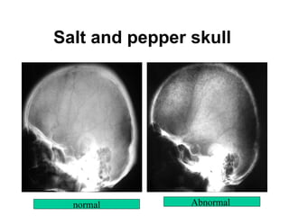 Salt and pepper skull   normal Abnormal  