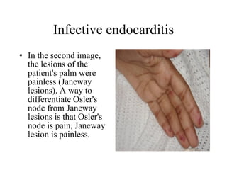 Infective endocarditis In the second image, the lesions of the patient's palm were painless (Janeway lesions). A way to differentiate Osler's node from Janeway lesions is that Osler's node is pain, Janeway lesion is painless.  