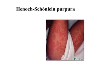 Henoch-Schönlein purpura 