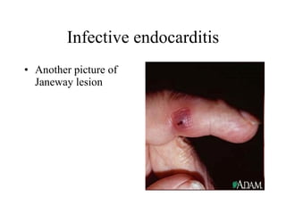 Infective endocarditis Another picture of Janeway lesion  