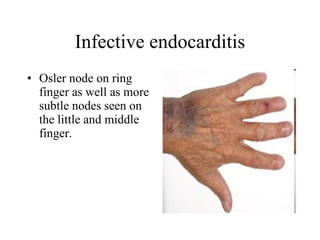 Infective endocarditis Osler node on ring finger as well as more subtle nodes seen on the little and middle finger.  
