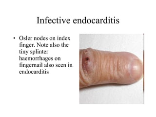 Infective endocarditis Osler nodes on index finger. Note also the tiny splinter haemorrhages on fingernail also seen in endocarditis  