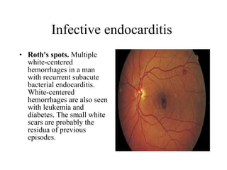 Infective endocarditis  Roth's spots.  Multiple white-centered hemorrhages in a man with recurrent subacute bacterial endocarditis. White-centered hemorrhages are also seen with leukemia and diabetes. The small white scars are probably the residua of previous episodes. 