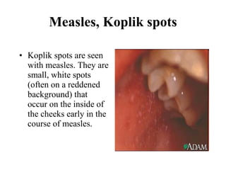 Measles, Koplik spots Koplik spots are seen with measles. They are small, white spots (often on a reddened background) that occur on the inside of the cheeks early in the course of measles.  