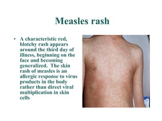 Measles rash A characteristic red, blotchy rash appears around the third day of illness, beginning on the face and becoming generalized.  The skin rash of measles is an allergic response to virus products in the body rather than direct viral multiplication in skin cells   