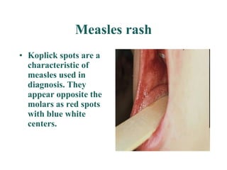 Measles rash Koplick spots are a characteristic of measles used in diagnosis. They appear opposite the molars as red spots with blue white centers.   