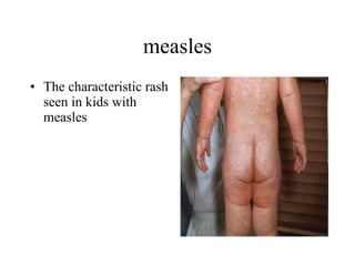 measles The characteristic rash seen in kids with measles  