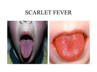 SCARLET FEVER 