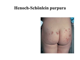 Henoch-Schönlein purpura 
