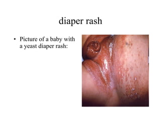 diaper rash Picture of a baby with a yeast diaper rash:  