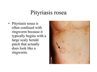 Pityriasis rosea Pityriasis rosea is often confused with ringworm because it typically begins with a large scaly herald patch that actually does look like a ringworm.  