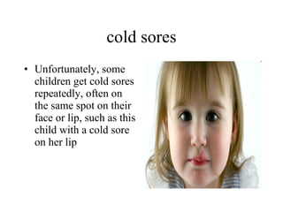 cold sores Unfortunately, some children get cold sores repeatedly, often on the same spot on their face or lip, such as this child with a cold sore on her lip  