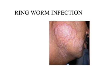 RING WORM INFECTION 