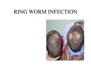 RING WORM INFECTION 