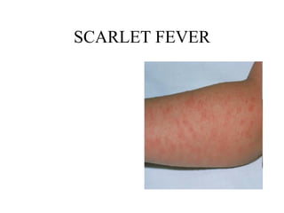 SCARLET FEVER 