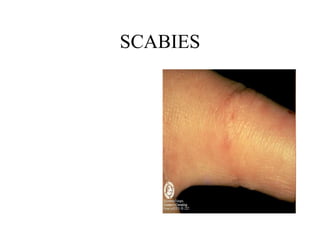 SCABIES 