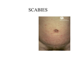 SCABIES 