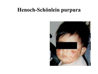 Henoch-Schönlein purpura 
