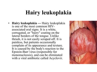 Hairy leukoplakia Hairy leukoplakia —  Hairy leukoplakia is one of the most common HIV-associated oral signs. It is a white, corrugated, or "hairy" coating on the lateral borders of the tongue. Unlike thrush, it is not easily scraped off. It is painless, but patients occasionally complain of its appearance and texture. It is caused by the body's reaction to the Epstein-Barr virus (responsible for mononucleosis), and can be eliminated with a viral antibiotic called Acyclovir.  