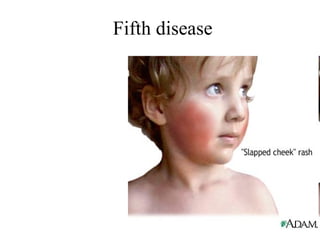 Fifth disease 