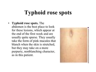 Typhoid rose spots Typhoid rose spots.  The abdomen is the best place to look for these lesions, which appear at the end of the first week and are usually quite sparse. They usually take the form of pink macules that blanch when the skin is stretched, but they may take on a more purpuric, nonblanching character, as in this patient.  
