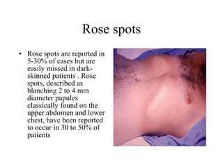 Rose spots Rose spots are reported in 5-30% of cases but are easily missed in dark-skinned patients . Rose spots, described as blanching 2 to 4 mm diameter papules classically found on the upper abdomen and lower chest, have been reported to occur in 30 to 50% of patients  
