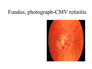 Fundus, photograph-CMV retinitis  